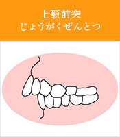 上顎前突じょうがくぜんとつ
