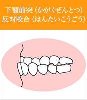 下顎前突かがくぜんとつ反対咬合はんたいこうごう
