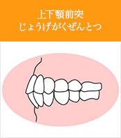 上下顎前突じょうげがくぜんとつ