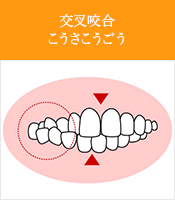 交叉咬合こうさこうごう