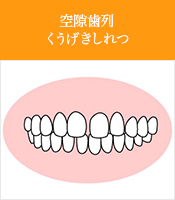 空隙歯列くうげきしれつ