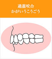 過蓋咬合かがいうこうごう